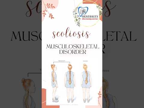 scoliosis|| Musculoskeletal disorder|| @DentoSity