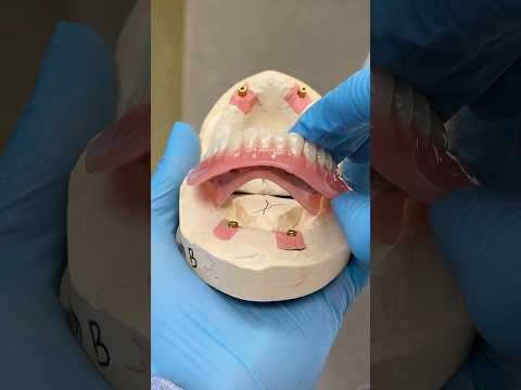 Hybrid Locator Dentures #lsk121shorts #dentist #teeth