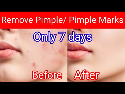 How To Remove Pimples Overnight | Acne Treatment | Indian Mom Reems|Acne Scar |Pimple Mark's