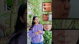 Kojic Acid Cream review |Pigmentation / Acne prone / Skin Whitening #kojicacid #skincare #kojicsoap