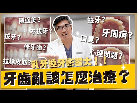 隱適美治療牙齒亂！隱形矯正如何處理牙齒亂？牙齒亂對生活會造成什麼影響？該選金屬矯正或隱形矯正？來聽聽楊醫師為大家介紹牙齒亂！｜【祐民牙醫－隱適美旗艦店】鑽石級楊大為醫師 #牙齒亂 #隱適美 #隱形矯正