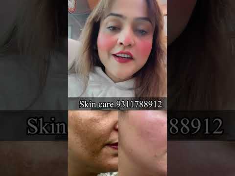 Skin care 9311788912 #pigmentation #skincare #acne #antiaging #skin #beauty #glowingskin #melasma