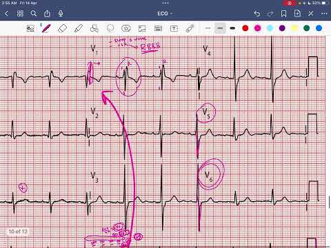 CASE_3 RBBB