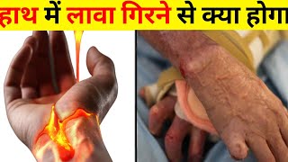 हाथ में लावा गिरने से क्या होगा | What happens if lava fell on hand #Shorts