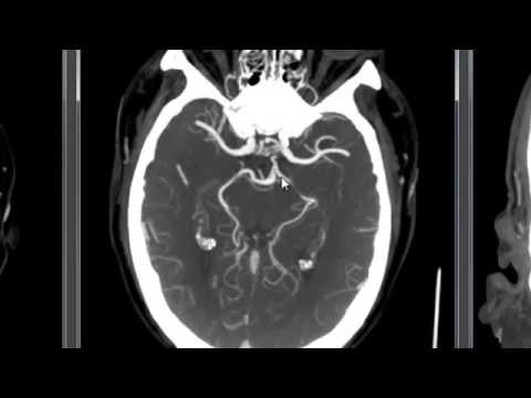 Large Artery Occlusion - Basilar