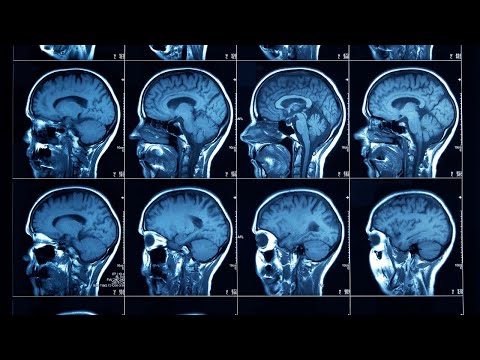 This Brain Implant will change the Healthcare System