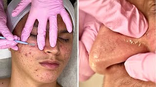 Clearing Teen Cystic Acne Facial! Pimple Extractions & MORE! @Jadeywadey180