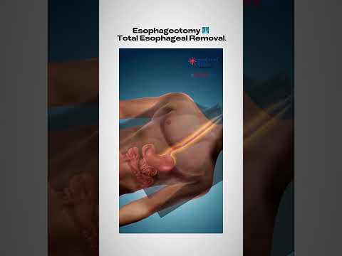 Esophagectomy Total  Esophageal Removal.