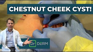 CHESTNUT Cheek Cyst! | Dr. Derm