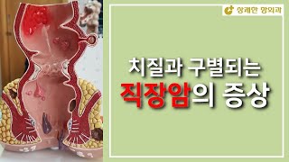 치질과 구별되는 직장암 증상