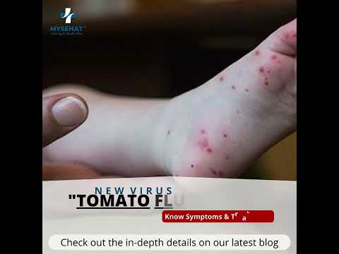 Tomato Flu In India | Know The Symptoms & Treatments | MYSEHAT