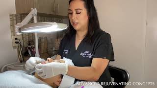 Teen Acne Facial: Extractions, Glycolic Peel & Microdermabrasion