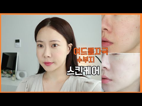 여드름 자국 흔적 지우기! 여름철 수부지 지성피부 스킨케어 루틴