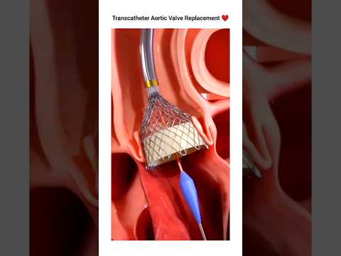 Transcatheter Aortic Valve Replacement #shorts #shortvideo #shortsfeed #youtube #mbbs #eduction