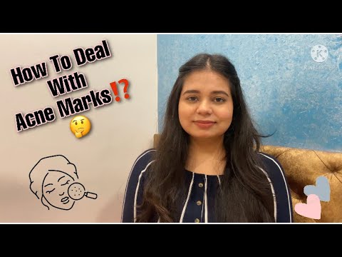 How To Deal With Acne Marks⁉️🤔 || One Stop Solution || Skincare✨