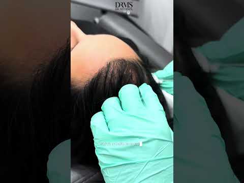 Losing Hair? You Need to Watch This! PRP Treatment Explained - DrMedispa