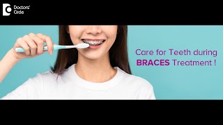 5 Oral Hygiene Care Tips During Clips or Orthodontic Treatment - Dr. Lahari A.S.R |Doctors' Circle