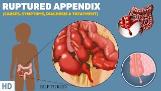 Ruptured Appendix: What It Feels Like and How to Recognize the Symptoms