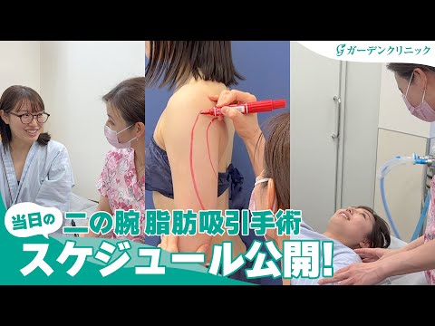 二の腕脂肪吸引手術 当日のスケジュール公開！