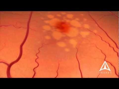 Wet Macular Degeneration