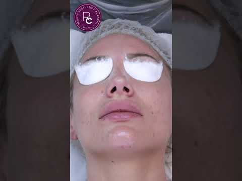 12 Step Chemical Skin Peel Procedure Tutorial | Level 4 VTCT Accredited