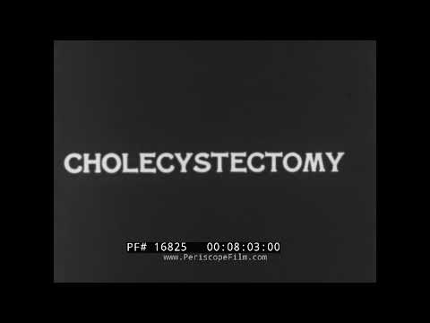 GALL BLADDER SURGERY  OPEN CHOLECYSTECTOMY  1950s MEDICAL FILM 16825