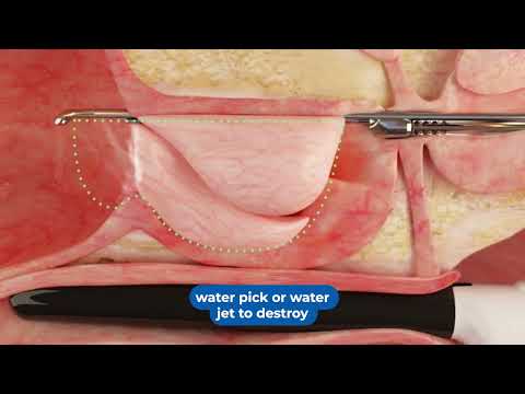 Aquablation Tool For Enlarged Prostate - Memorial Healthcare System