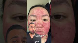 acne fulminans journey | Dr. Somji