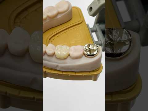 Gold and Zen Enamel Molars #lsk121shorts #dentist #teeth