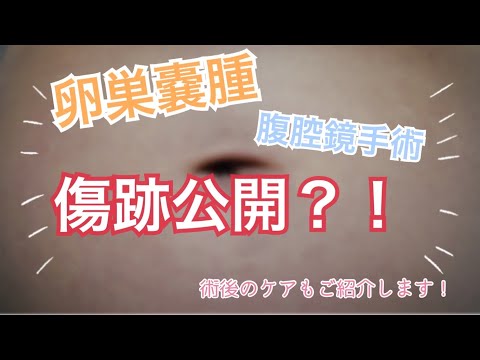 【卵巣嚢腫】術後傷跡公開？！傷跡ケアについても！