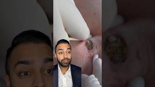 The BIGGEST blackhead extraction ever? | Dr. Somji reacts