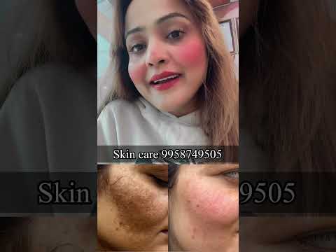 Skin care 9958749505#pigmentation #skincare #acne #antiaging #skin #beauty #glowingskin #melasma