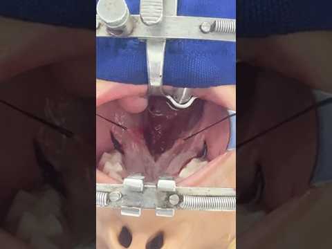 Best redo cleft palate surgeon hospital in India - Richardsons Face