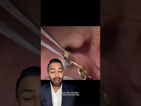 This Blackhead Removal from the Ear is a Must-Watch! - Dr Somji Reacts