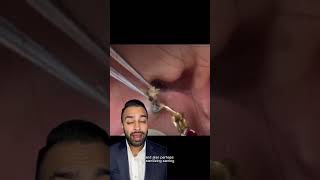 This Blackhead Removal from the Ear is a Must-Watch! - Dr Somji Reacts