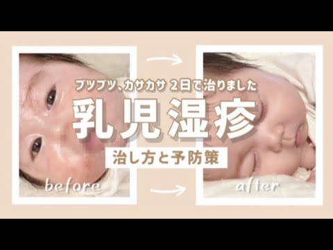 - 乳児湿疹 - 皮膚科医に聞いた〈治し方〉と〈予防策〉【生後2ヶ月の肌トラブル】