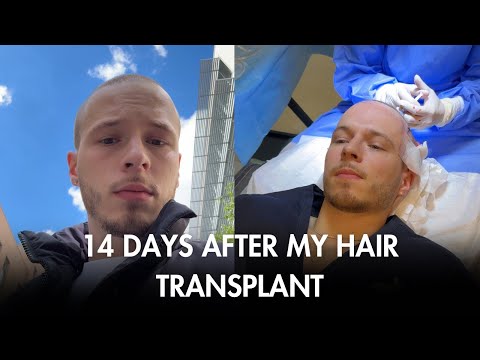 14 day update after my hair transplant in Turkey