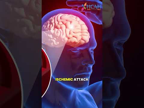 What Is Stroke? Types, Symptoms, and Important Facts