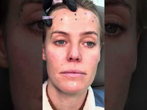 Botox Technique for 3 Areas: Dr. Somji’s Expert Injection Without Dropping Eyebrows!