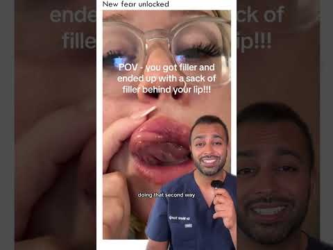 ‼️Migrated lip filler reaction‼️