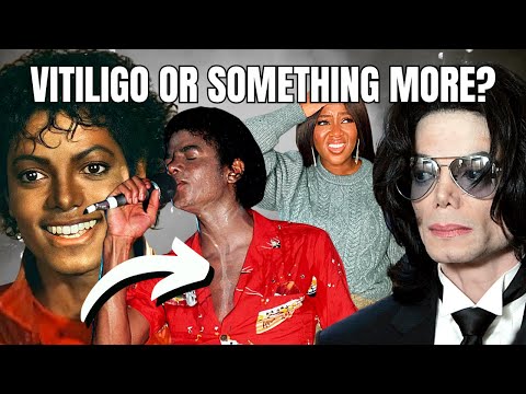 Unraveling the Mystery of Michael Jackson's Changing Skin Tone