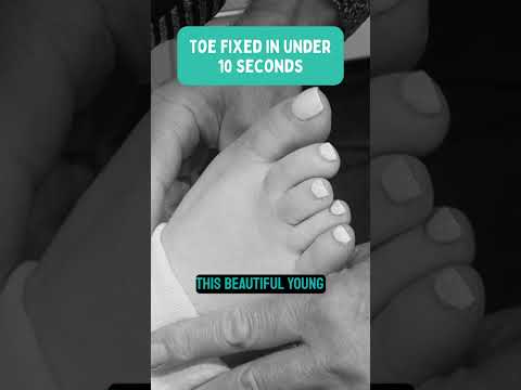 Toe fixed in under 10 seconds 😱