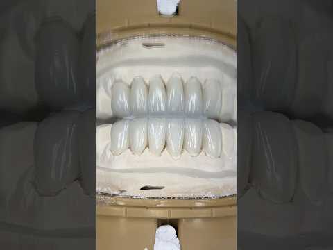 Lower Hollywood Ceramic Veneers #teeth #dentist #lsk121shorts