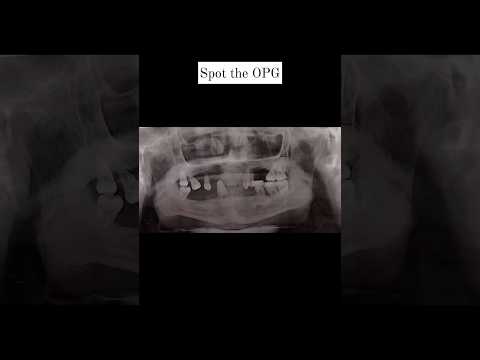 Spot the OPG?.#opg #rpd #fpd #teethmobility #extractions #toothextractions #radiology