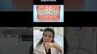 How Can Orthodontic Elastics Help With Your Braces?!