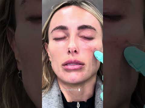 Amber Turner's Skin Recovery with Polynucleotides! - DrMedispa