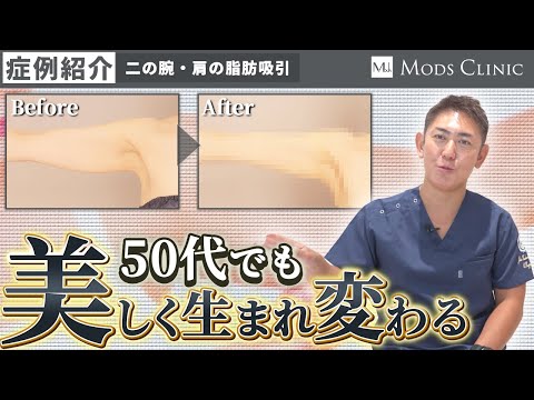 【症例紹介】50代の二の腕の脂肪吸引！若い世代との効果や仕上がりに違いはある？（52歳/156cm/44kg）/北條誠至 院長｜Mods Clinic モッズクリニック（脂肪吸引・注入）