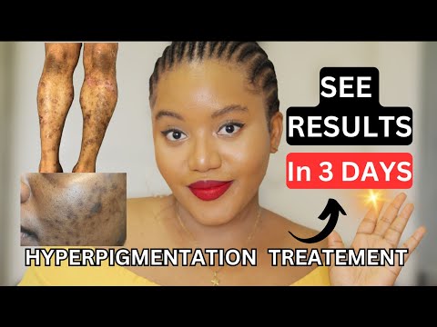 HOW TO FADE HYPERPIGMENTATION FAST 💨 | COMPLETE BODY KIT + FULL ROUTINE