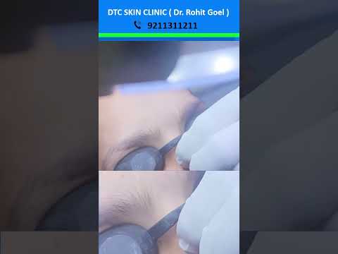 Mole Removal Treatment | Dr. Rohit Goel