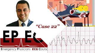 #EPEC​​​ ECG Cases (Case 22), Do I need to be scared when I see this rhythm??